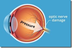 glaucoma-pressure-330x220@2x