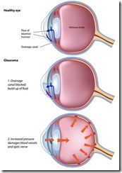 glaucoma1