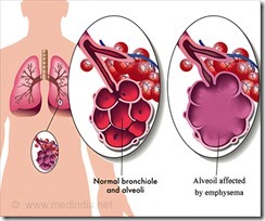 emphysema