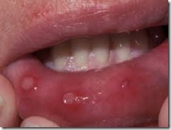 Apthous ulcers