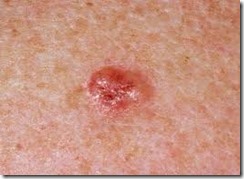 Basal cell carcinoma