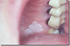 Leukoplakia