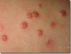 Molluscum contagiosum