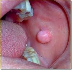 Oral fibroma