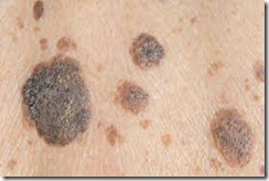 Seborrheic keratosis