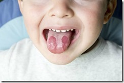 geographic-tongue-in-toddlers-1