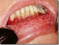 oral lichen planus