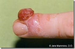 pyogenic granuloma