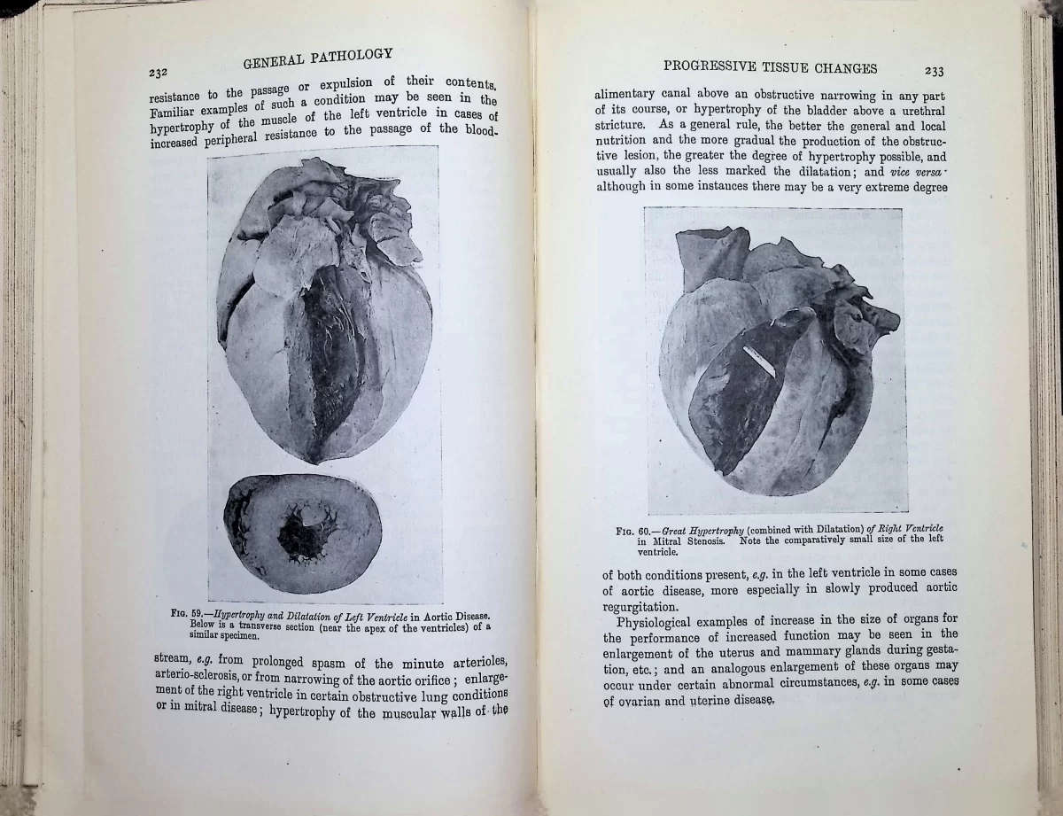 Photographs of hypertrophied human heart ventricles from pathology text