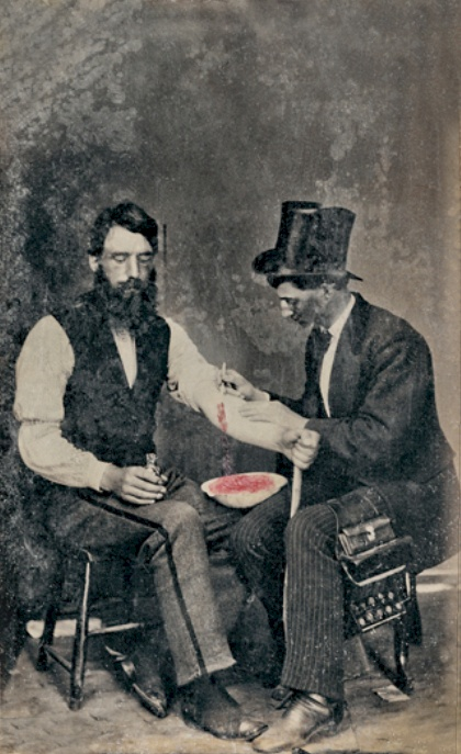 Rare 1860 tintype photograph showing a practitioner performing bloodletting on a seated patient, with a basin collecting the blood.